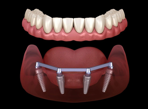 Full Mouth Implants Camarillo