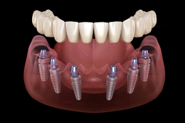 Hybrid Implant Dentures Camarillo