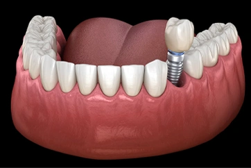 Single Dental Implant Camarillo