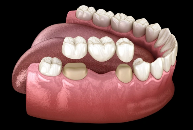 Dental bridges Camarillo