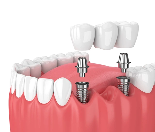 Single Tooth Implants and Bridges