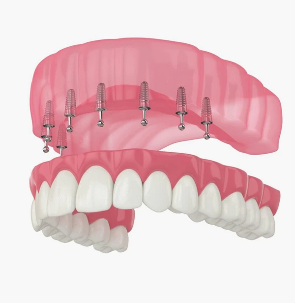 snap in implant dentures camarillo
