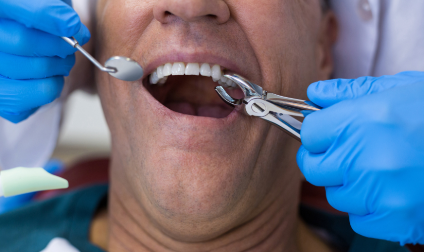 tooth extraction