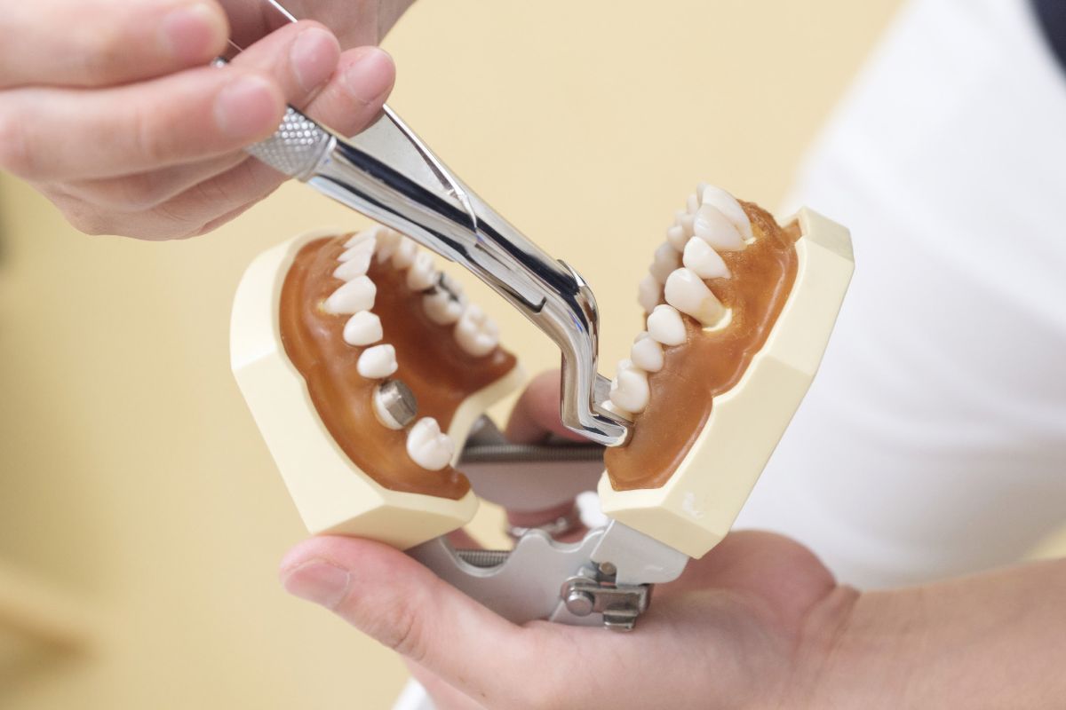 How Long Does It Take to Recover After a Tooth Extraction?