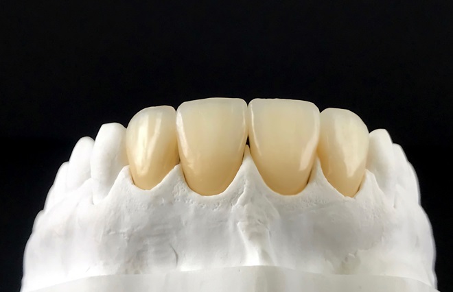 Can Dental Crowns Be Customized to Match Your Natural Teeth?